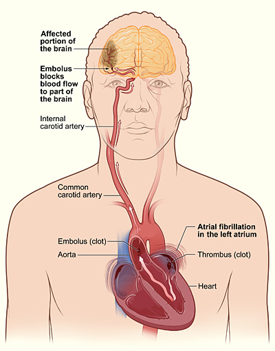 atrial_fib_stroke