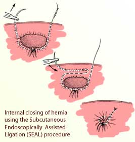 Inguinal Hernia